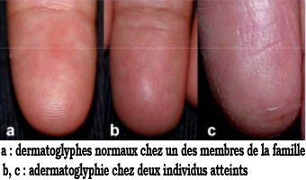 Comparaison d'un doigt « normal » et d'un doigt d'adermatoglyphile